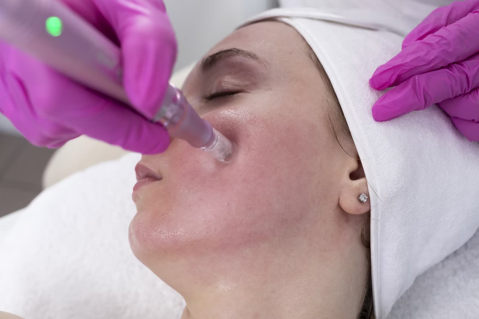 Diamond microdermabrasion facial treatment being performed in Cheltenham, treatment in progress